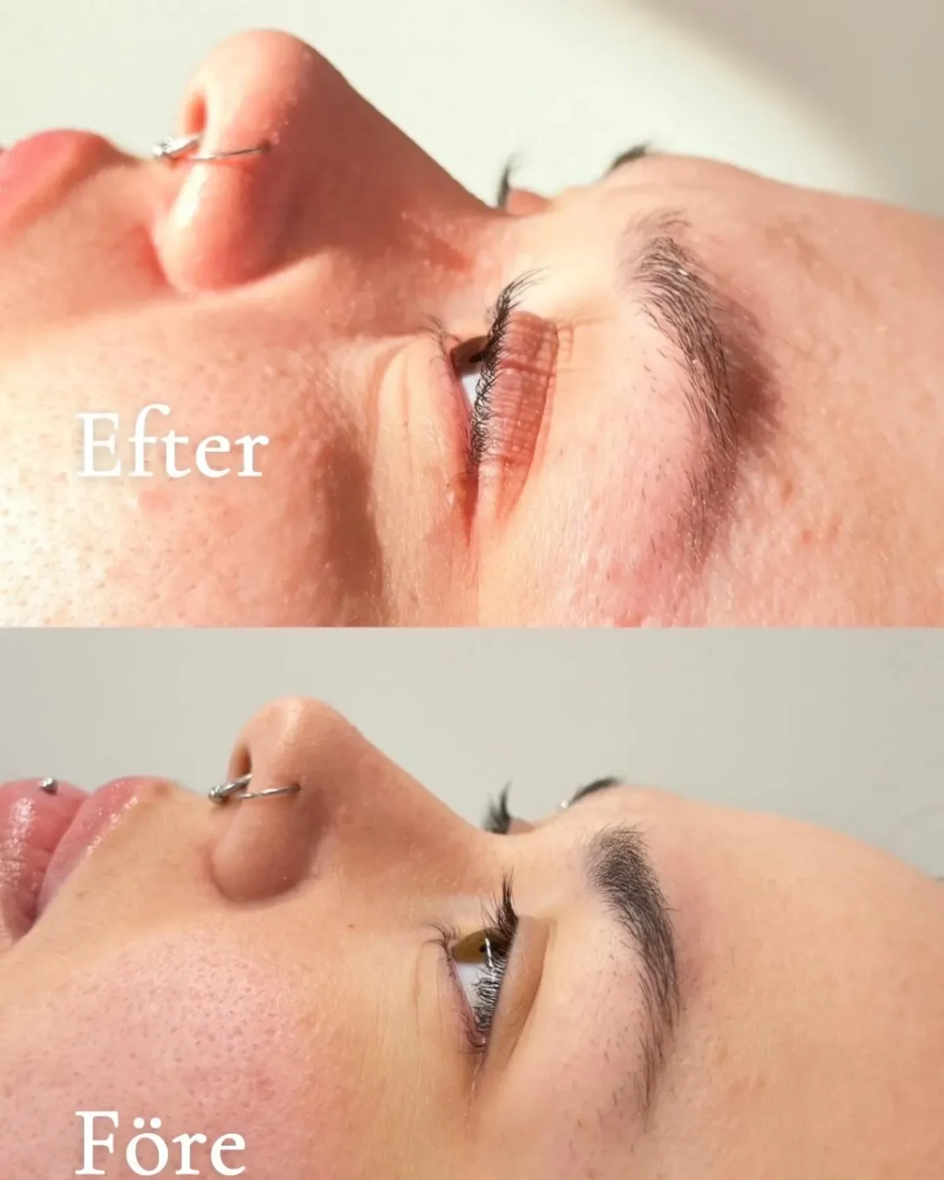 Exempel på Browlift utfört av företaget